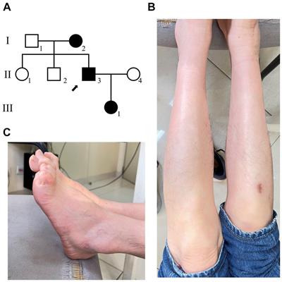 Frontiers Case Report A Novel Variant H N In Myelin Protein Zero